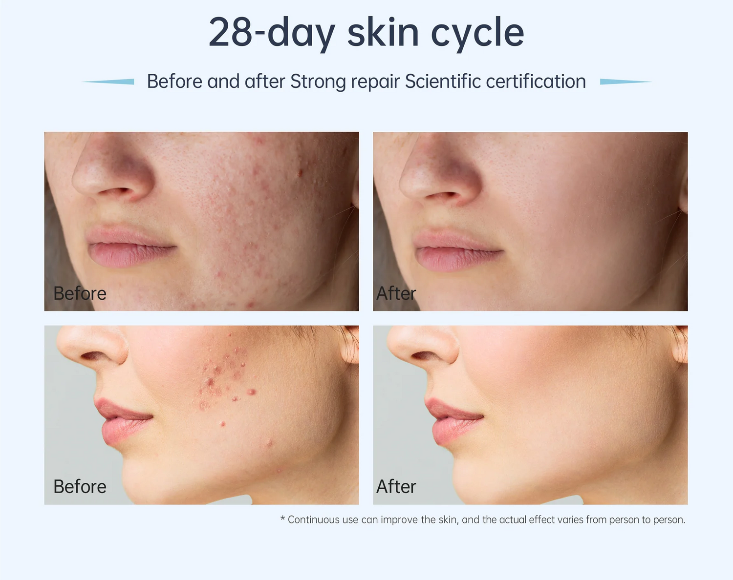 Before and after 28 days of using Dr. Pen microneedling device showing significant improvements in skin smoothness, reduced scars, wrinkles, and stretch marks. Safe for all skin types with three-lock needle system, delivering salon-quality results at home and saving up to $4,800 annually.
