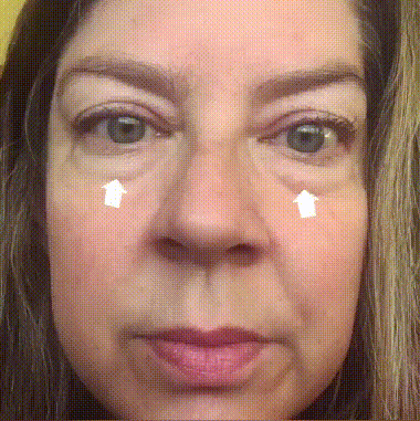 Before and after results of two women showing improved skin brightness, reduced wrinkles,refined pores,and smoother texture after using the Dr. Pen M8S microneedling device