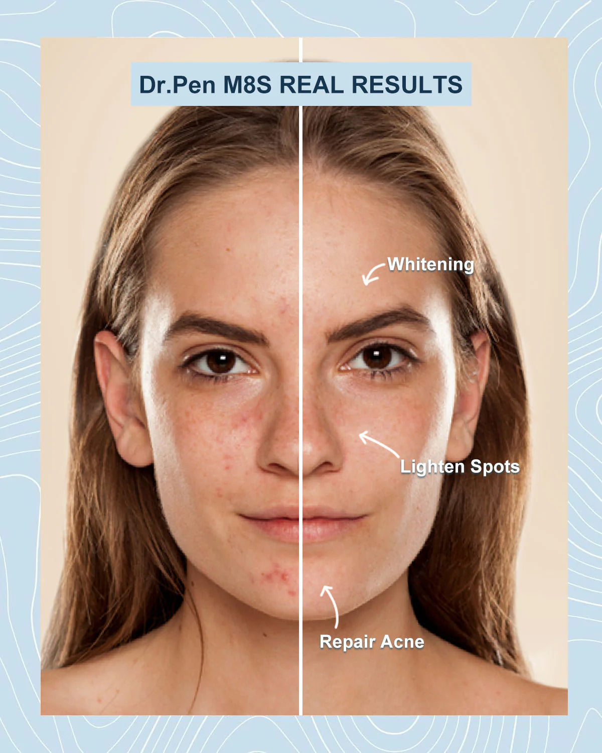 Before and after comparison of a woman’s face showing Dr. Pen M8S microneedling results including acne repair,spot lightening,skin whitening,and improved complexion.