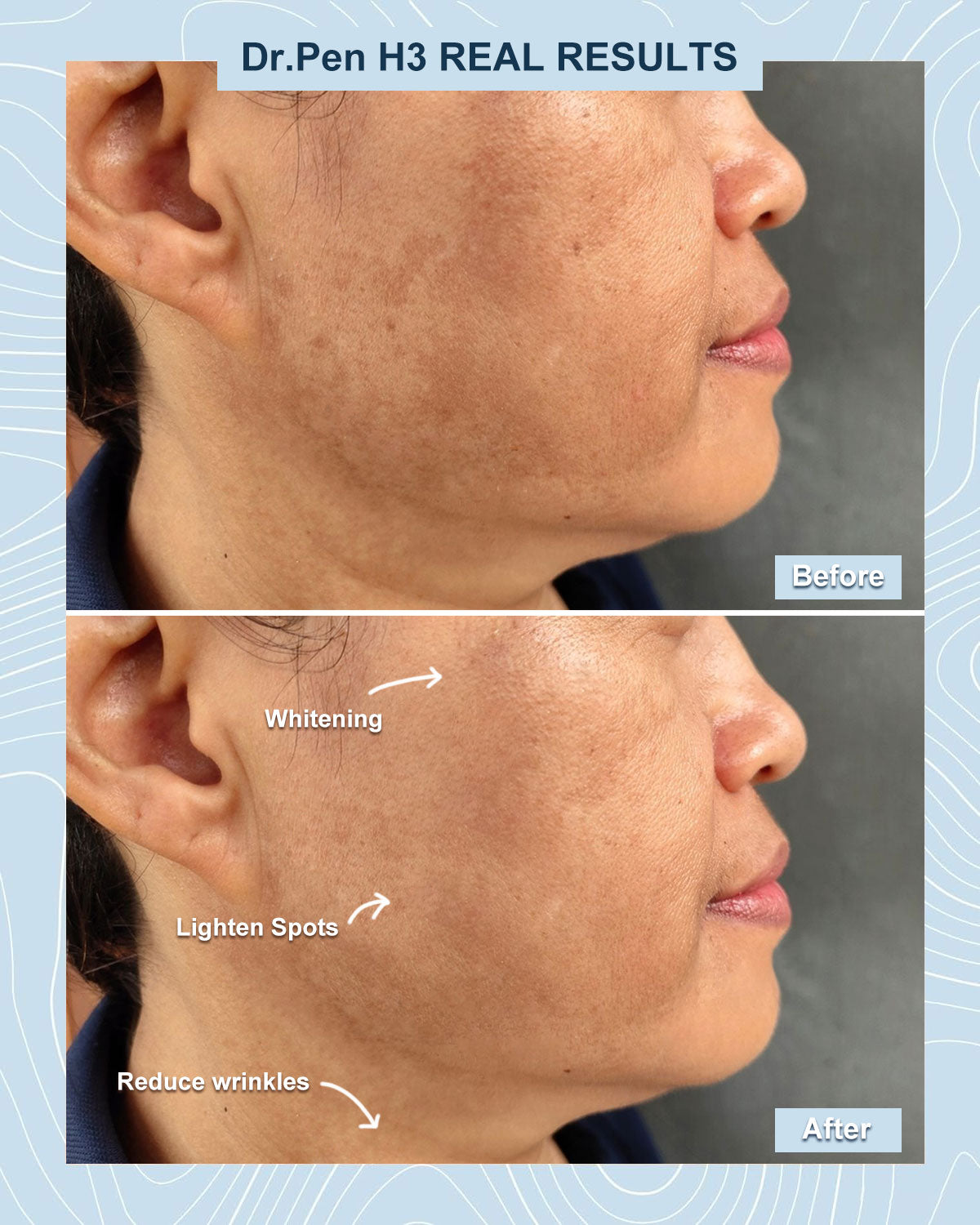 Before and after comparison showing Dr. Pen H3 microneedling results: brightened, even-toned skin with reduced dark spots and acne scars, refined pores, smoother texture, and a radiant, youthful glow.