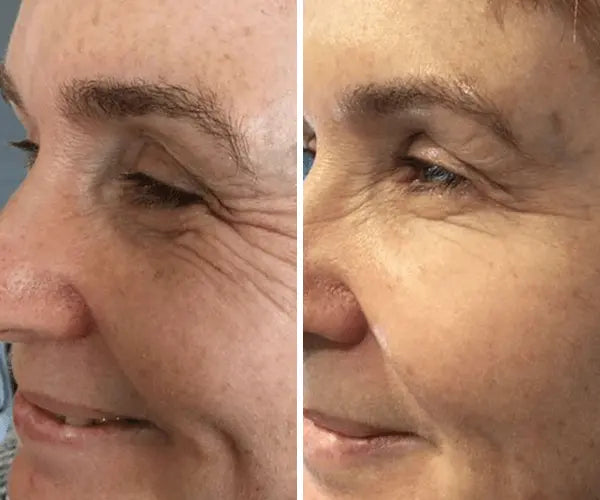 Dr Pen Ultima A10 Microneedling Pen with FREE 12 Replacement Cartridges