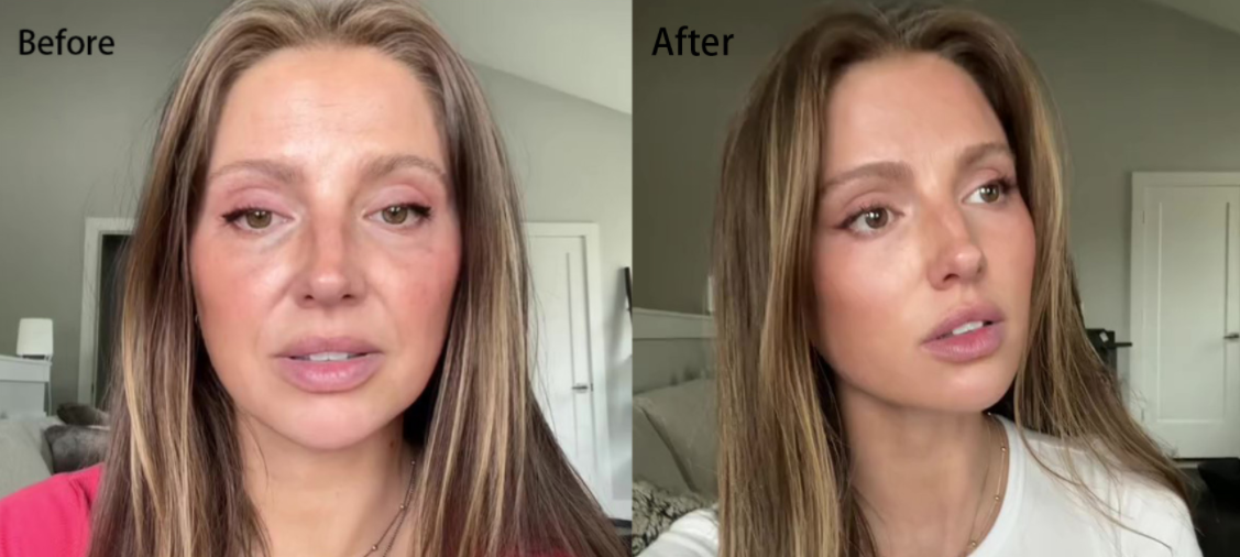 Before and after using bio PEN Q2 on woman’s face,reducing redness and fine lines for smoother,glowing skin with microneedling.