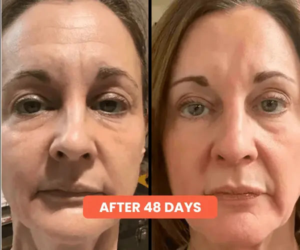 Dr Pen Ultima A10 Microneedling Pen with FREE 12 Replacement Cartridges
