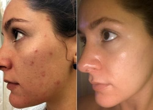 Before and after microneedling results using Dr. Pen – visible reduction of acne scars, facial pits, and dark marks after 5 sessions. User Sherry M. reports dramatically improved skin texture and renewed confidence with at-home skincare.