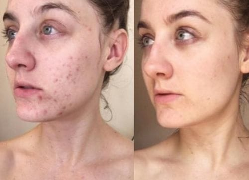 Before and after image showing dramatic improvement in facial redness and acne scars after using the newest Dr. Pen model. User Alice R. noticed visible results in just 2 microneedling sessions, no longer needing heavy makeup for coverage.