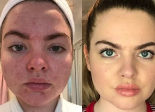 Before and after image showing significant improvement in facial acne scars and red marks after 6 microneedling sessions with Dr. Pen. User Loree C. reports a boost in self-confidence and clearer skin after following her boss’s skincare advice.