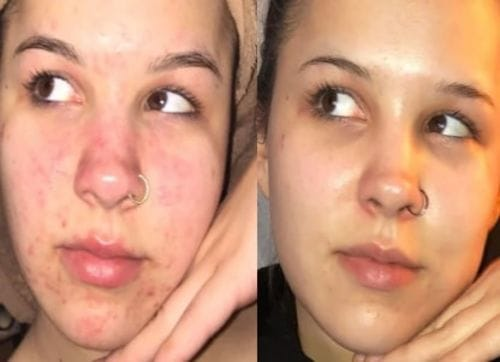 Before and after image showing visible improvement in deep acne pits and dark spots after at-home microneedling with Dr. Pen. User Theresa F. reports painless sessions, easy setup with the included manual, and noticeable skin transformation over time.