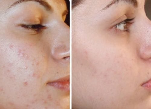 Before and after image showing skin improvement after using Dr. Pen Ultima model for at-home microneedling. User Ivy B. reports no pain, dermatologist-level results, and major savings by using affordable extra tips instead of in-office treatments.