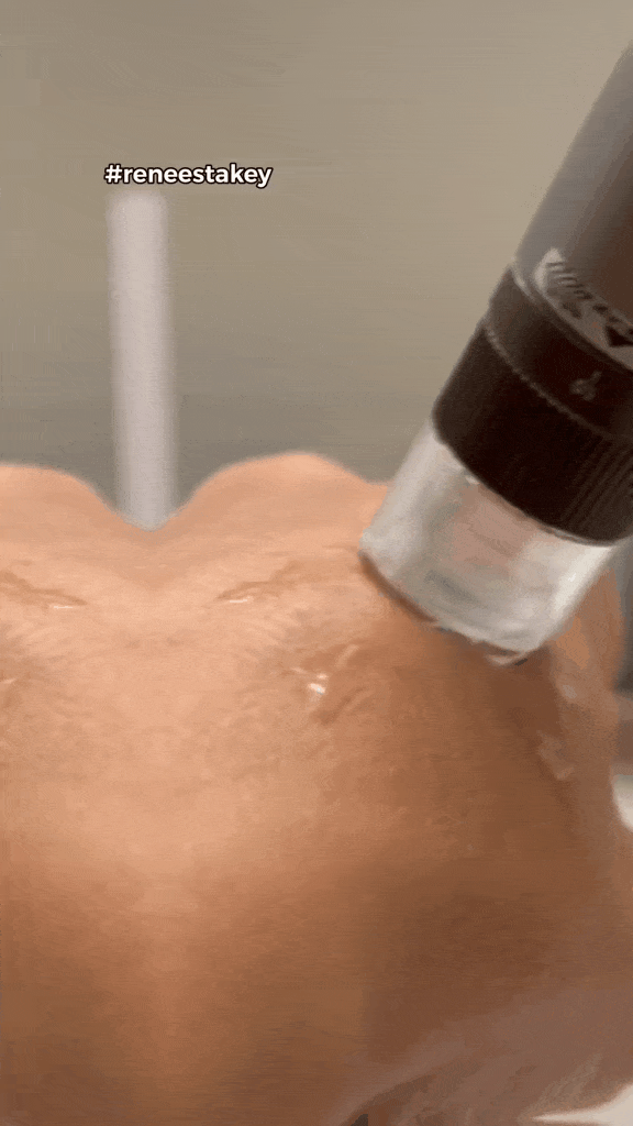 Animated GIF showing facial skin texture improvement with reduced acne scars and smoother, more even complexion.