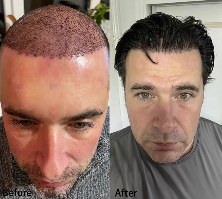 Before and after bio PEN Q2 hair growth results on man,showing thicker hair and reduced baldness with microneedling and EMS.